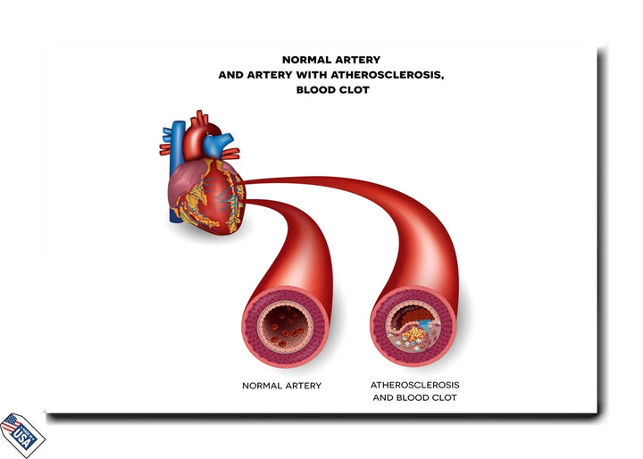 Atherosclerosis & Artery Health - Medical Illustration