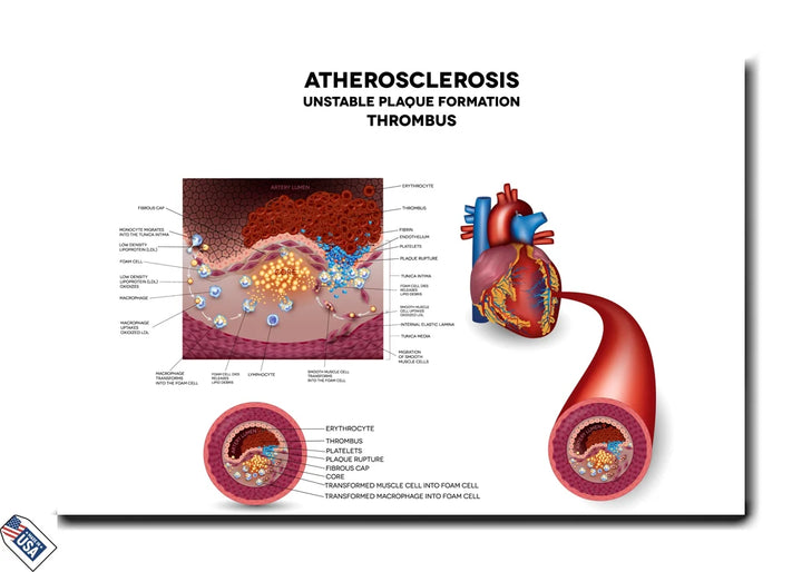 Atherosclerosis and Thrombosis - Plaque Formation Process