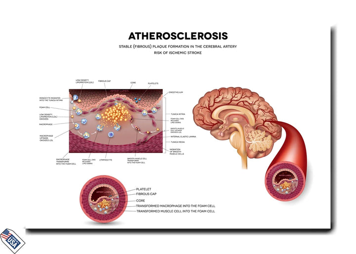 Atherosclerosis and Ischemic Stroke - Stable Plaque Formation