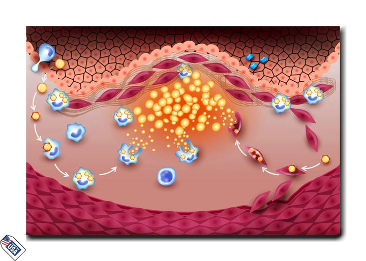 Atherosclerosis - Cellular Interaction in Plaque Formation